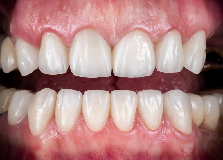 emax press ceramic veneers